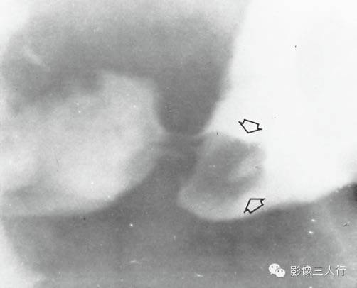 胃肠道病变的