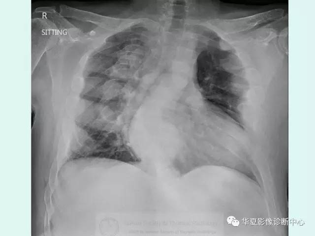 【病例】地中海贫血一例CT