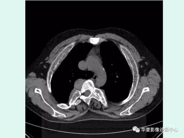 【病例】地中海贫血一例CT