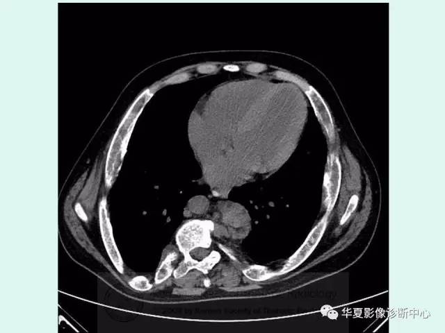 【病例】地中海贫血一例CT