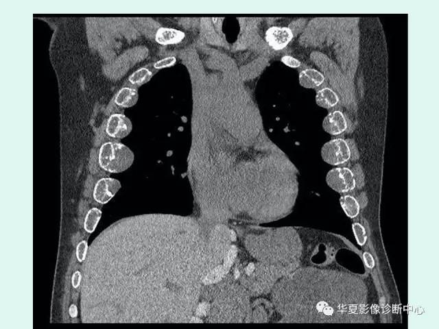 【病例】地中海贫血一例CT