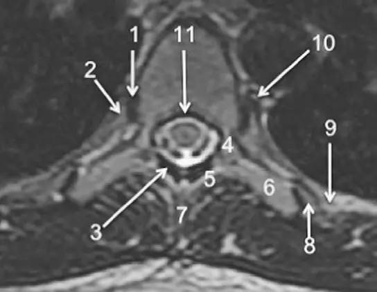 MRI 下脊椎基本解剖集锦：胸腰椎
