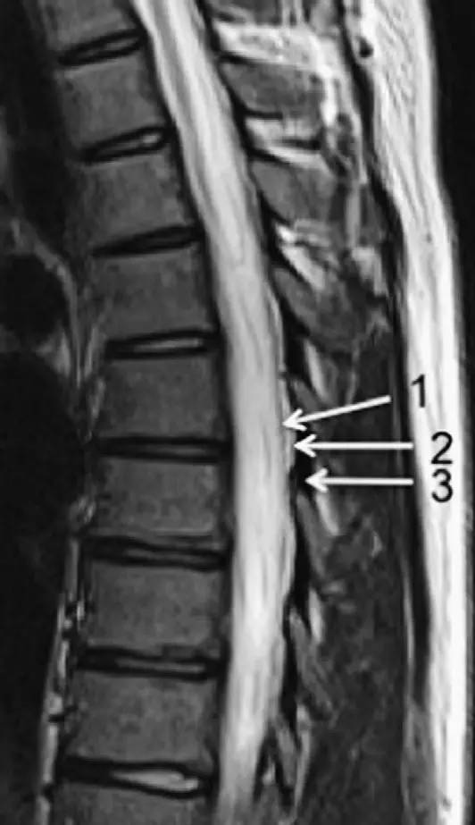 MRI 下脊椎基本解剖集锦：胸腰椎