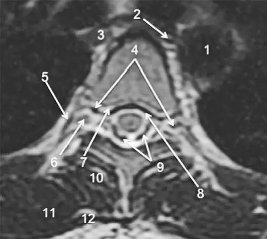 MRI 下脊椎基本解剖集锦：胸腰椎
