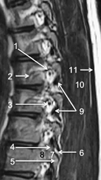 MRI 下脊椎基本解剖集锦：胸腰椎