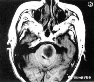 手把手教你会读片——脑脓肿 手把手教你会读片——脑脓肿