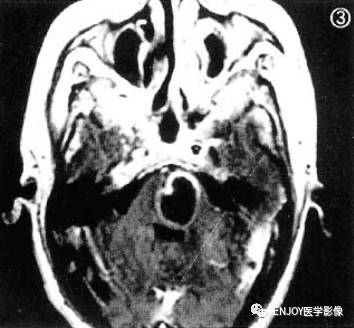 手把手教你会读片——脑脓肿