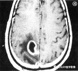 手把手教你会读片——脑脓肿 手把手教你会读片——脑脓肿