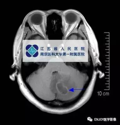 手把手教你会读片——脑脓肿 手把手教你会读片——脑脓肿