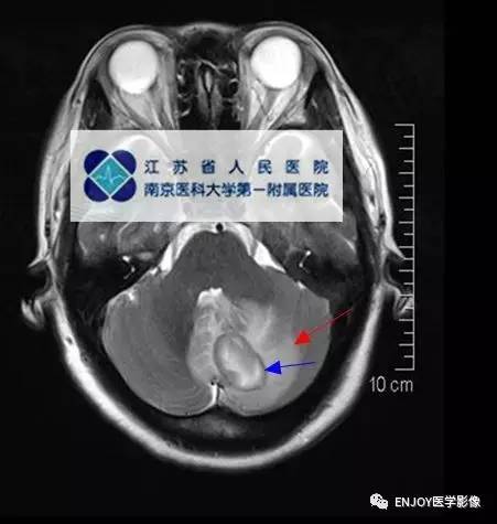 手把手教你会读片——脑脓肿 手把手教你会读片——脑脓肿