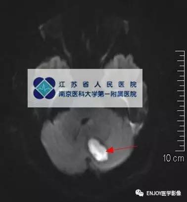 手把手教你会读片——脑脓肿 手把手教你会读片——脑脓肿