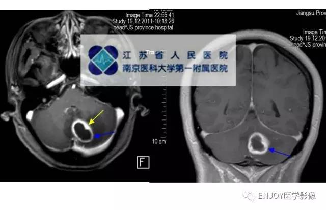 手把手教你会读片——脑脓肿 手把手教你会读片——脑脓肿