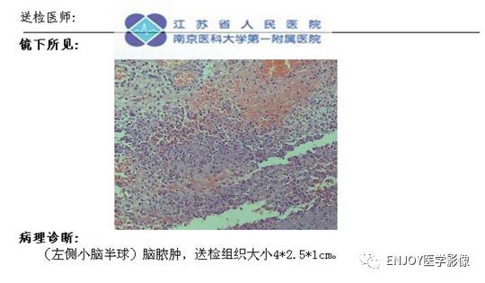手把手教你会读片——脑脓肿 手把手教你会读片——脑脓肿