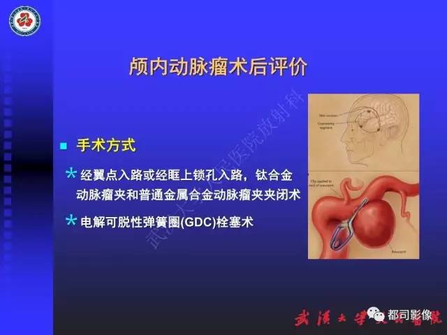 【PPT】CTA在血管病变术后评价中的应用