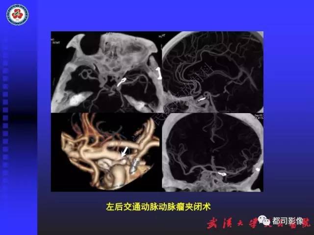 【PPT】CTA在血管病变术后评价中的应用