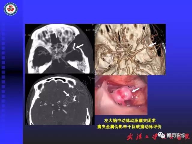【PPT】CTA在血管病变术后评价中的应用