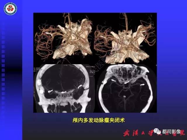 【PPT】CTA在血管病变术后评价中的应用