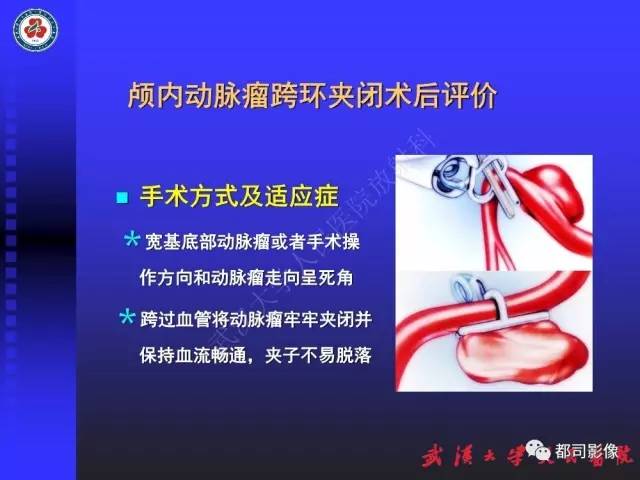 【PPT】CTA在血管病变术后评价中的应用