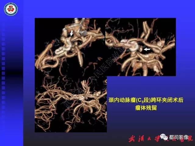 【PPT】CTA在血管病变术后评价中的应用