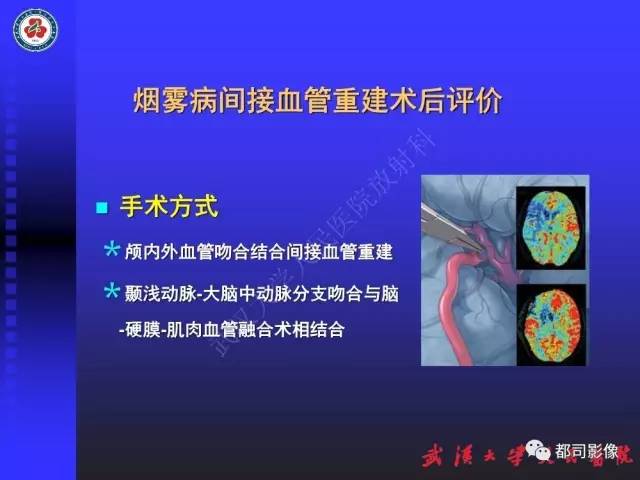 【PPT】CTA在血管病变术后评价中的应用