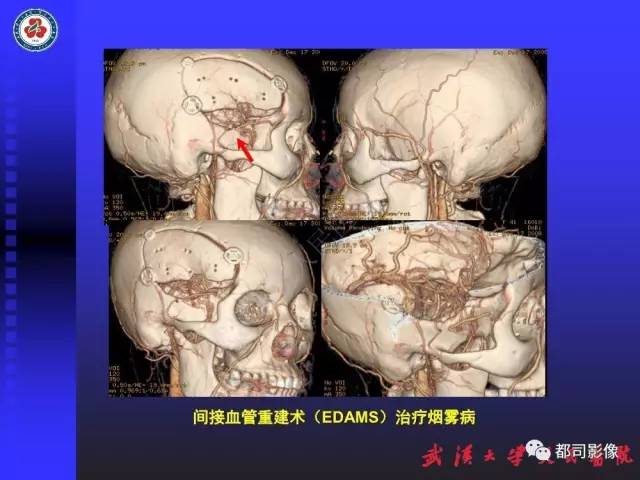 【PPT】CTA在血管病变术后评价中的应用
