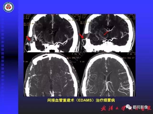 【PPT】CTA在血管病变术后评价中的应用