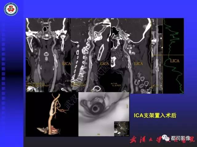 【PPT】CTA在血管病变术后评价中的应用
