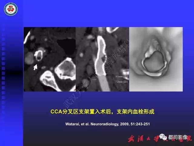 【PPT】CTA在血管病变术后评价中的应用