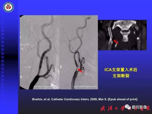 【PPT】CTA在血管病变术后评价中的应用