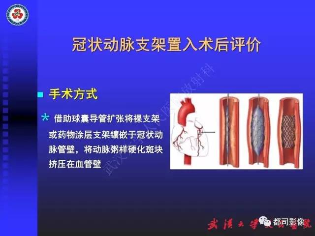 【PPT】CTA在血管病变术后评价中的应用
