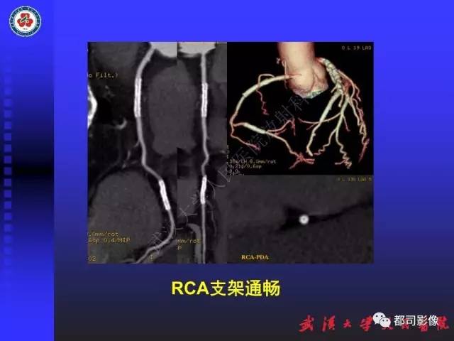 【PPT】CTA在血管病变术后评价中的应用