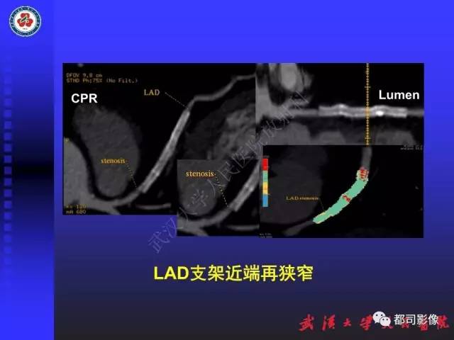 【PPT】CTA在血管病变术后评价中的应用