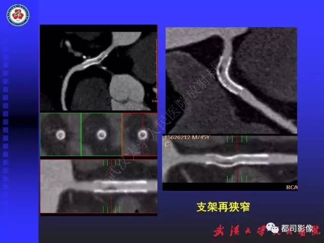 【PPT】CTA在血管病变术后评价中的应用