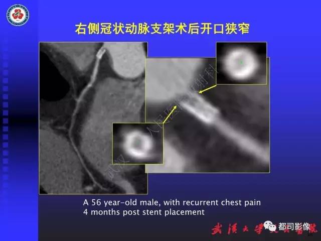【PPT】CTA在血管病变术后评价中的应用