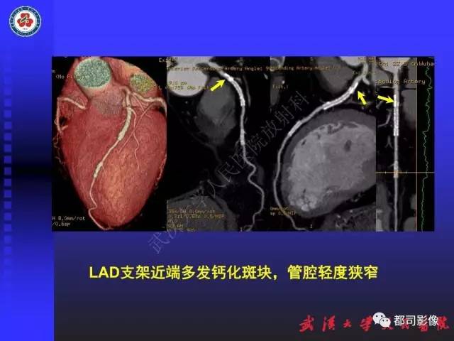 【PPT】CTA在血管病变术后评价中的应用