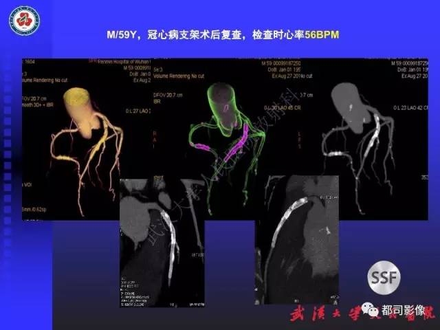 【PPT】CTA在血管病变术后评价中的应用
