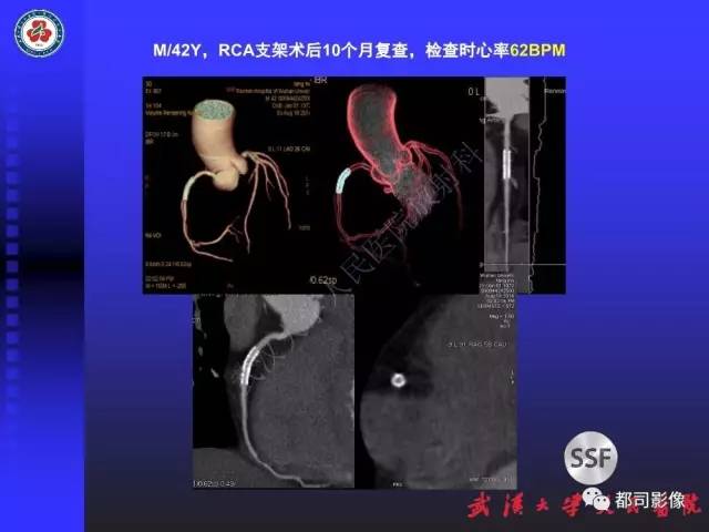 【PPT】CTA在血管病变术后评价中的应用
