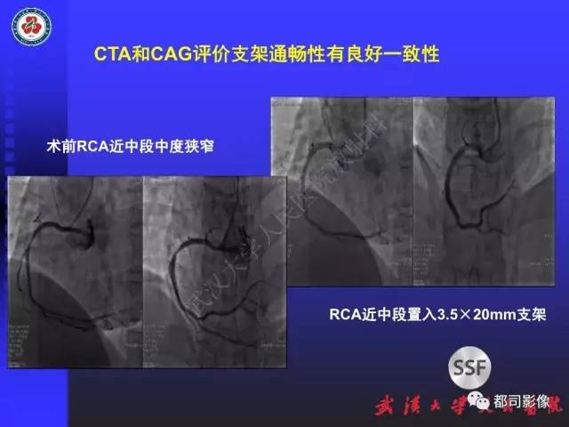 【PPT】CTA在血管病变术后评价中的应用