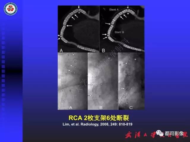 【PPT】CTA在血管病变术后评价中的应用