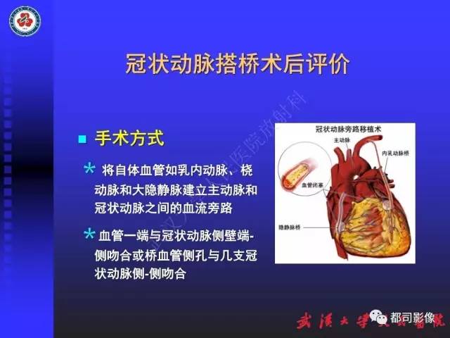 【PPT】CTA在血管病变术后评价中的应用