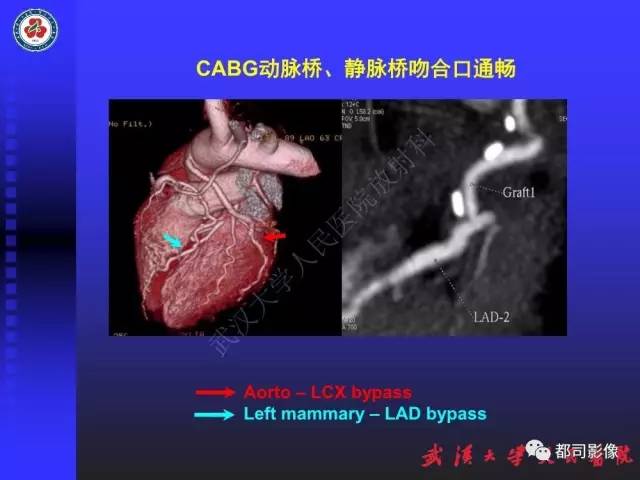 【PPT】CTA在血管病变术后评价中的应用