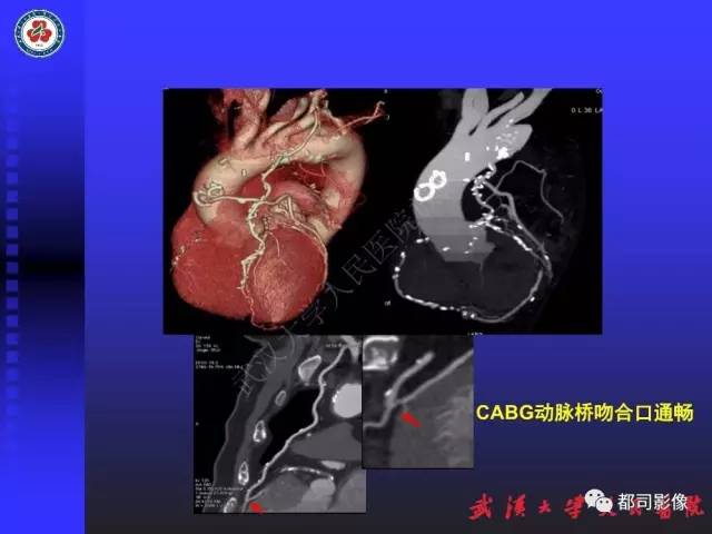 【PPT】CTA在血管病变术后评价中的应用