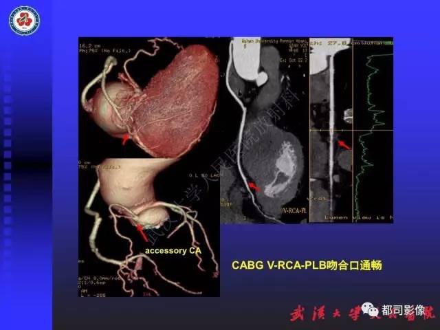 【PPT】CTA在血管病变术后评价中的应用