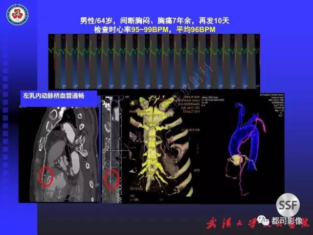 【PPT】CTA在血管病变术后评价中的应用