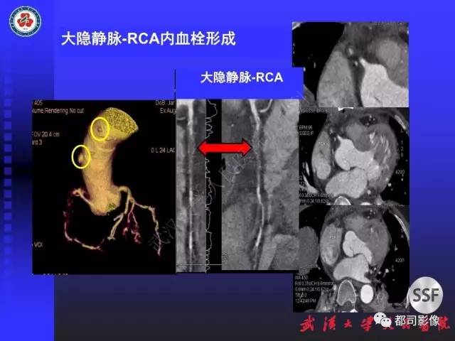 【PPT】CTA在血管病变术后评价中的应用