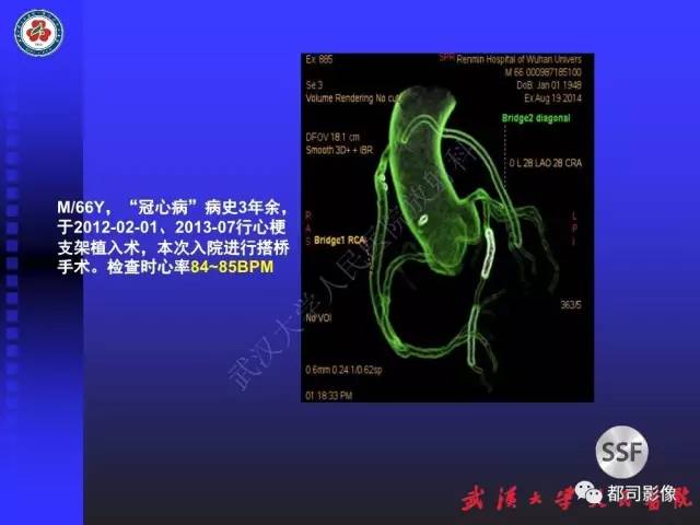 【PPT】CTA在血管病变术后评价中的应用