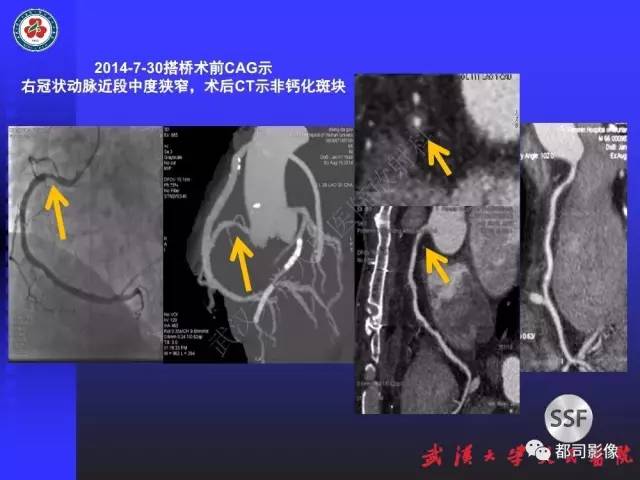 【PPT】CTA在血管病变术后评价中的应用
