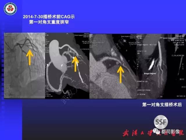 【PPT】CTA在血管病变术后评价中的应用