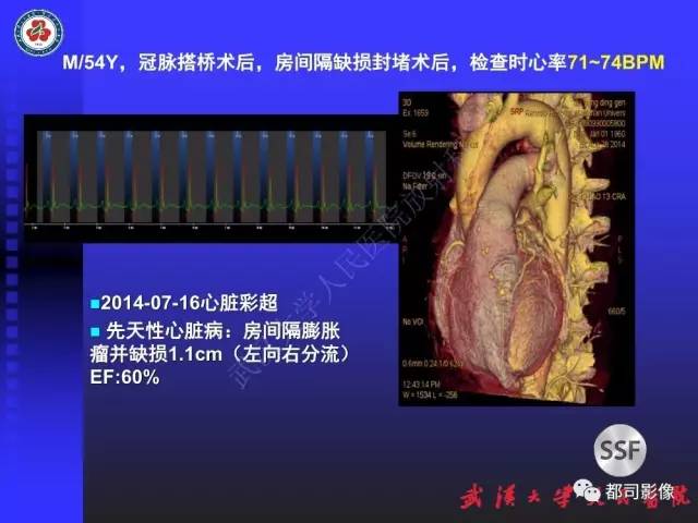 【PPT】CTA在血管病变术后评价中的应用