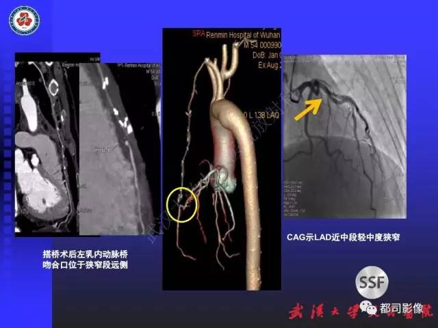 【PPT】CTA在血管病变术后评价中的应用